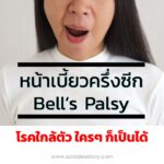 หน้าเบี้ยวครึ่งซีก (Bell’s Palsy ) โรคใกล้ตัว ใครๆ ก็เป็นได้ 