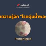 ทำความรู้จัก “โรคตุ่มน้ำพอง”