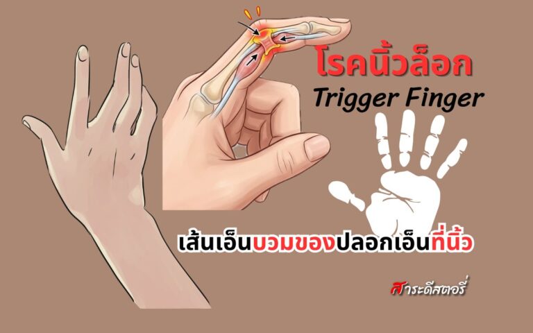 โรคนิ้วล็อก คืออะไร?